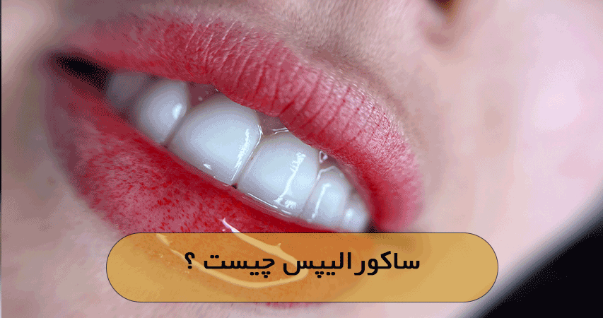 ساکورالیپس چیست ؟