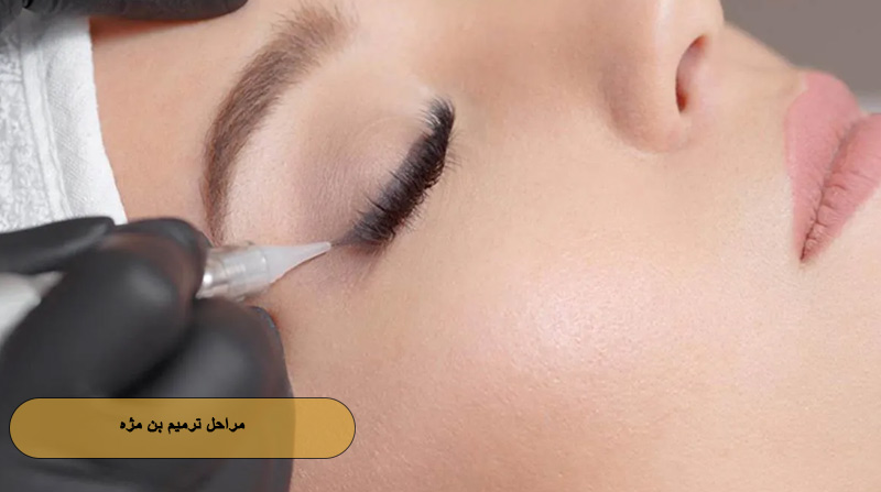 مراحل ترمیم بن مژه