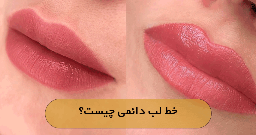 خط لب دائمی چیست؟
