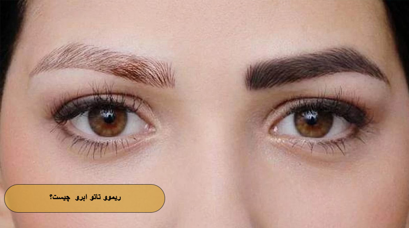 ریموو تاتو ابرو چیست؟