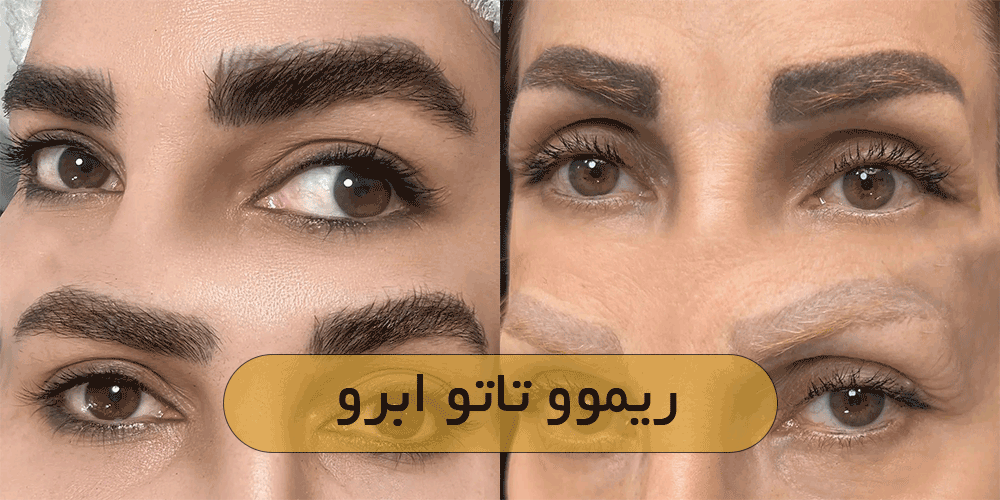 ریموو تاتو ابرو