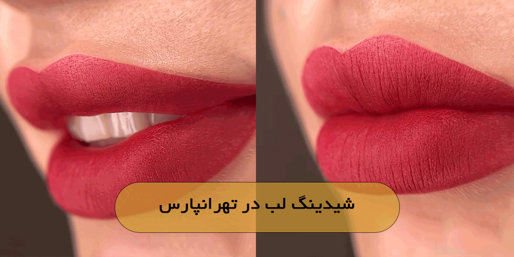 شیدینگ لب در تهرانپارس
