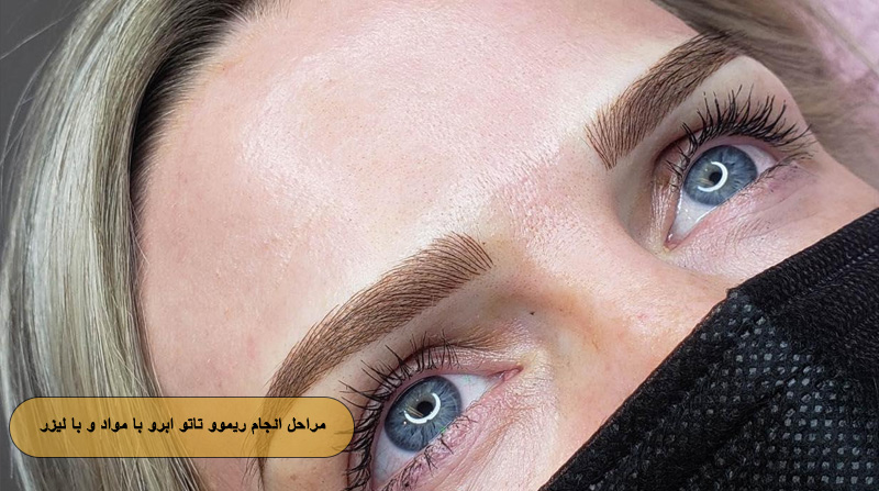 مراحل انجام ریموو تاتو ابرو با مواد و با لیزر