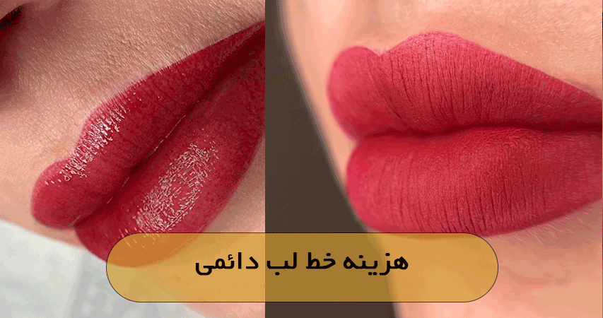 هزینه خط لب دائمی