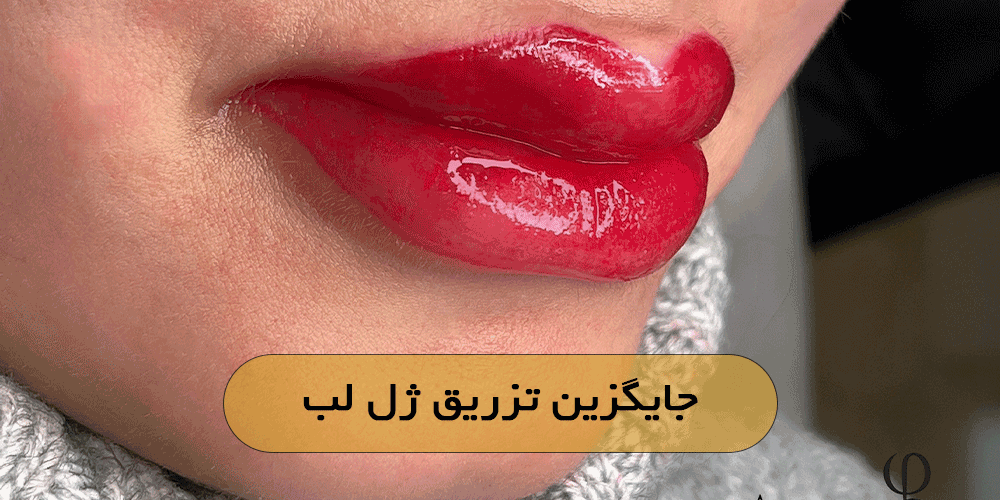 جایگزین تزریق ژل لب