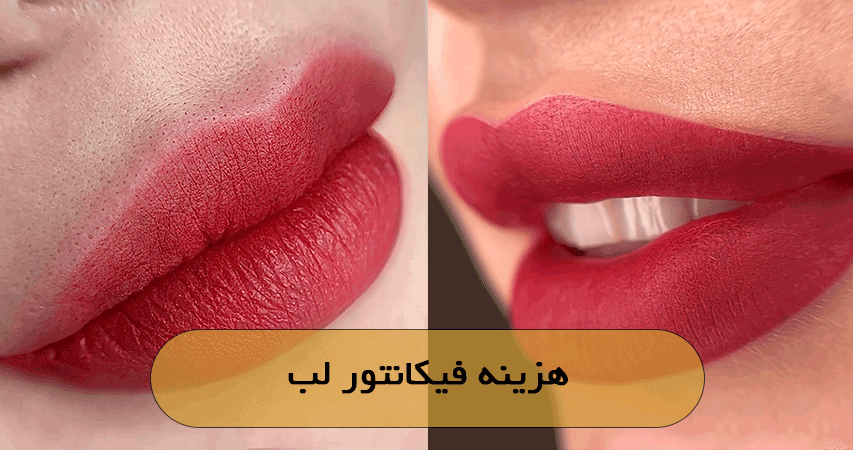هزینه فیکانتور لب