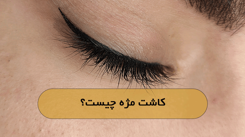 کاشت مژه چیست؟