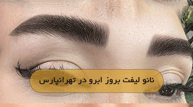 نانو لیفت بروز ابرو در تهرانپارس