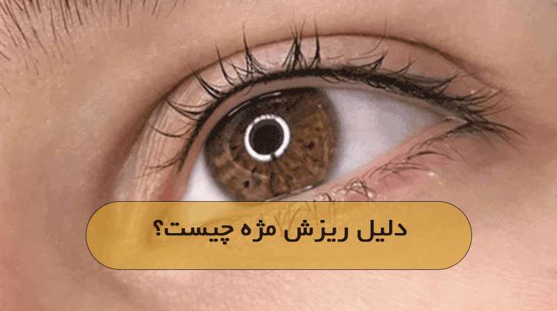 دلیل ریزش مژه چیست؟