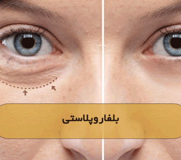 بلفاروپلاستی