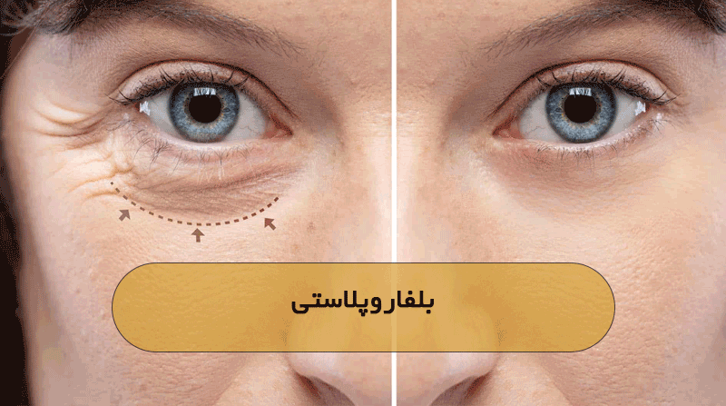 بلفاروپلاستی