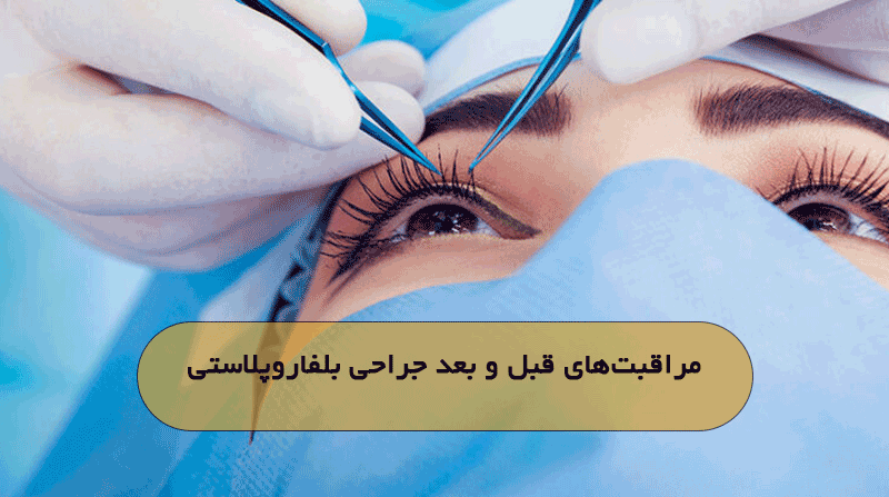 مراقبت‌های قبل و بعد جراحی بلفاروپلاستی