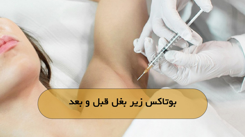بوتاکس زیر بغل قبل و بعد