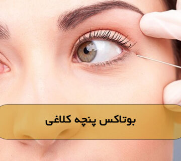 بوتاکس پنچه کلاغی