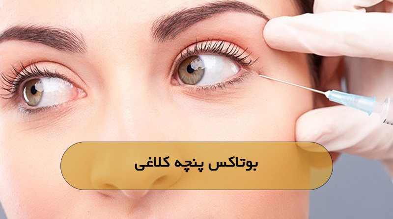 بوتاکس پنچه کلاغی