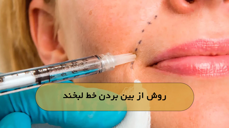 روش از بین بردن خط لبخند