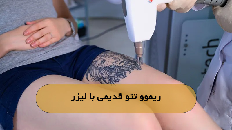 ریموو تتو قدیمی با لیزر