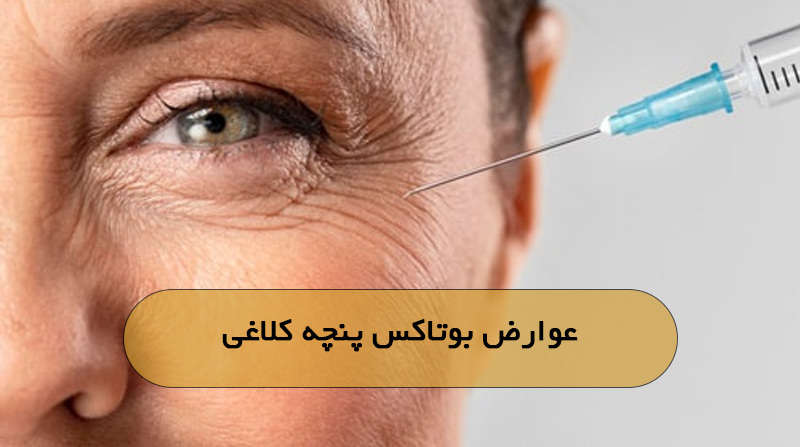 عوارض بوتاکس پنچه کلاغی