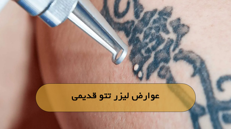 عوارض لیزر تتو قدیمی