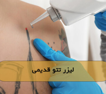 لیزر تتو قدیمی