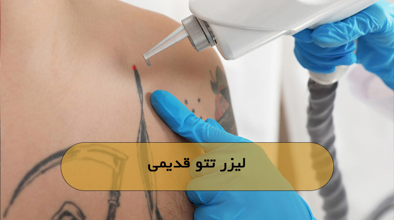 لیزر تتو قدیمی