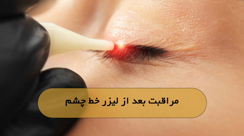 مراقبت بعد از لیزر خط چشم