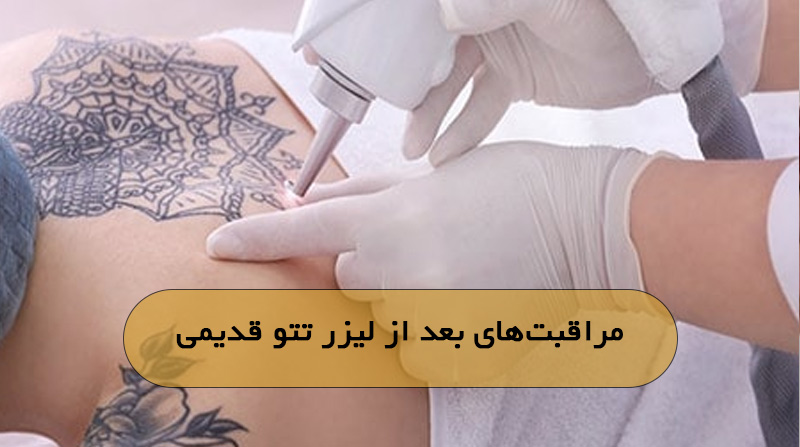 مراقبت‌های بعد از لیزر تتو قدیمی