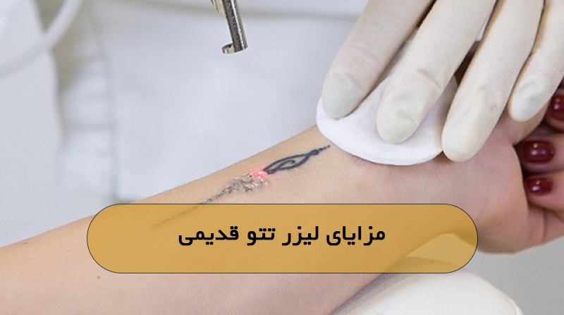 مزایای لیزر تتو قدیمی