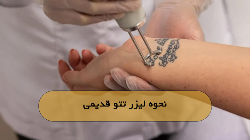 نحوه لیزر تتو قدیمی
