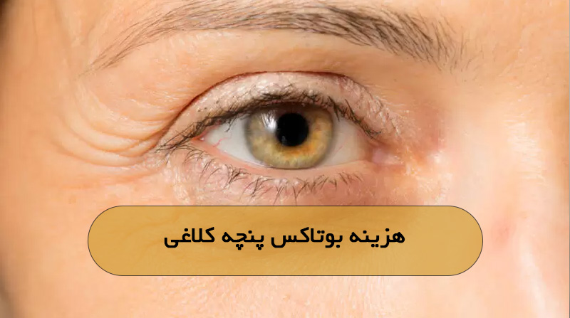 هزینه بوتاکس پنچه کلاغی