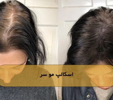 اسکالپ مو سر