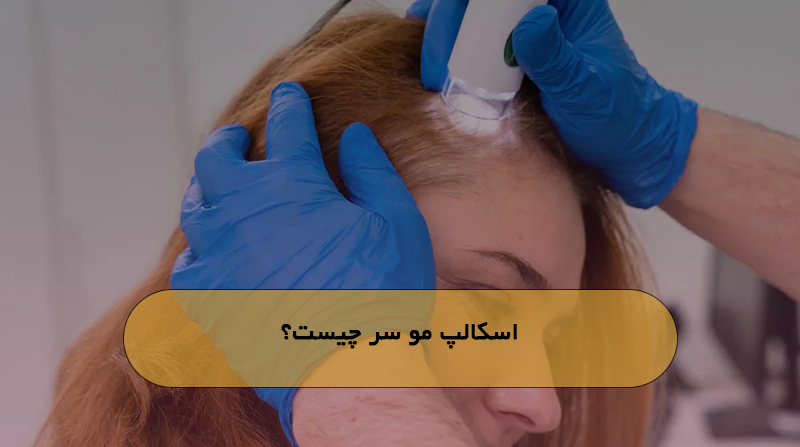 اسکالپ مو سر چیست؟
