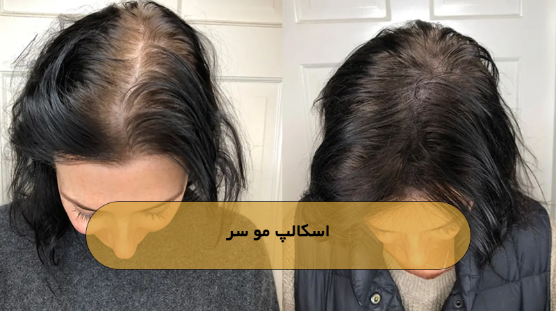 اسکالپ مو سر