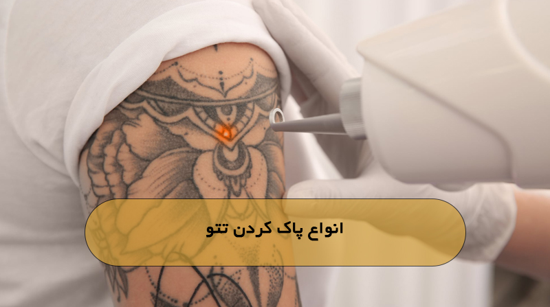 انواع پاک کردن تتو