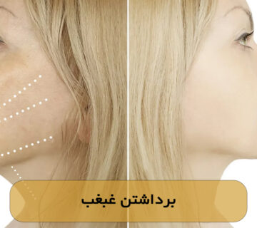 برداشتن غبغب