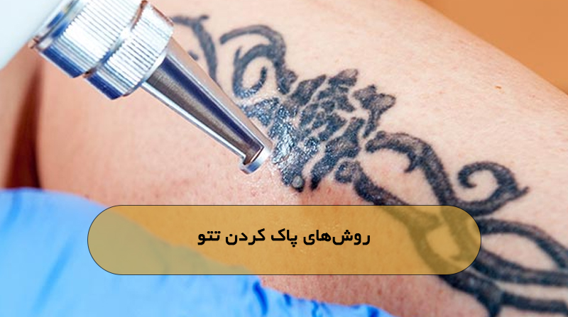 روش‌های پاک کردن تتو