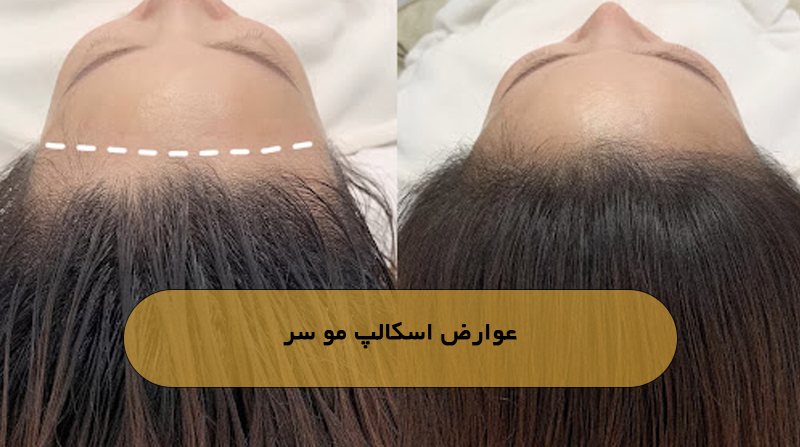 عوارض اسکالپ مو سر