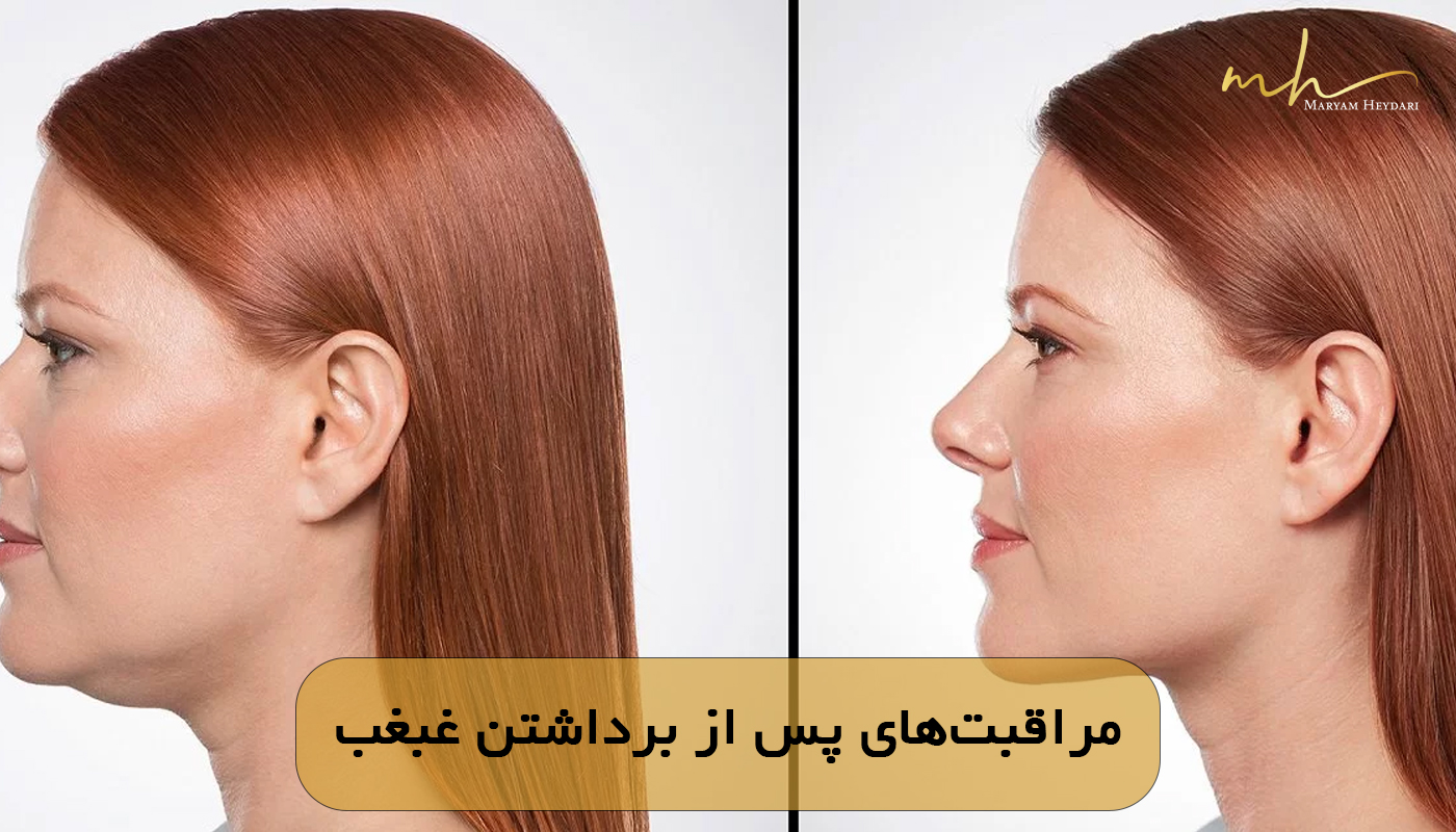 مراقبت‌های پس از برداشتن غبغب