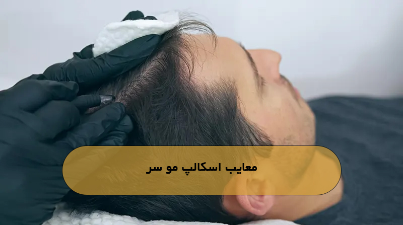 معایب اسکالپ مو سر