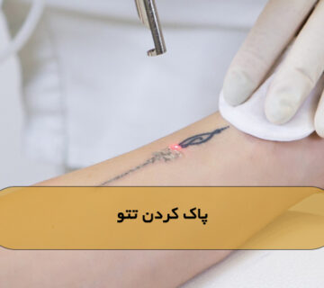 پاک کردن تتو