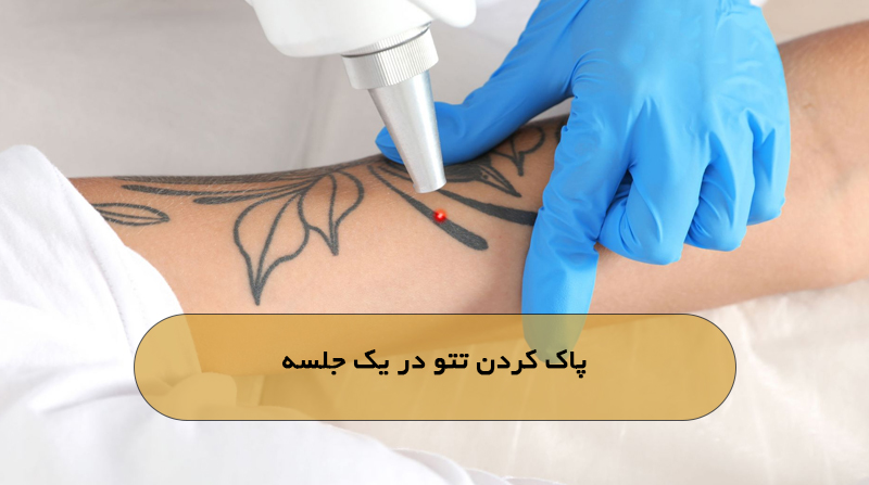 پاک کردن تتو در یک جلسه