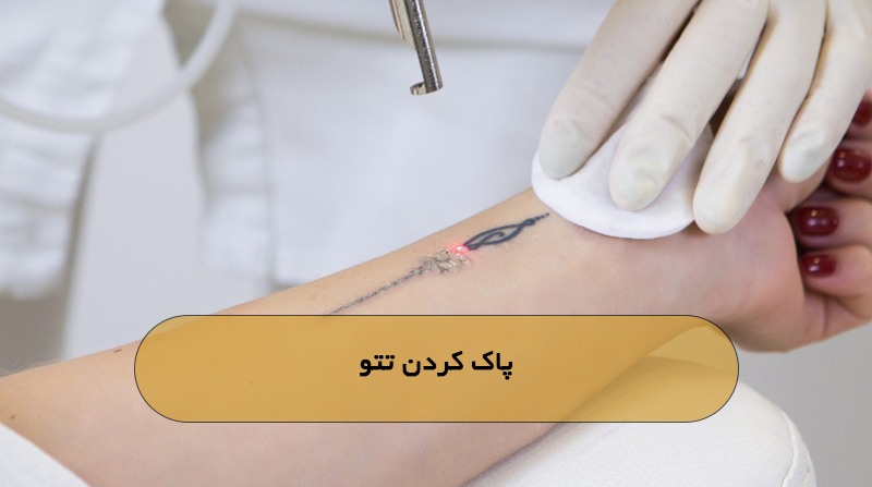 پاک کردن تتو