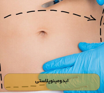 ابدومینوپلاستی