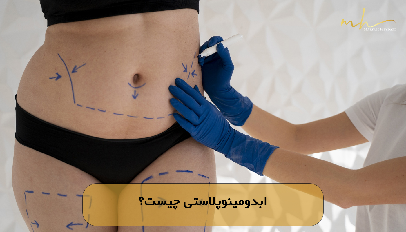 ابدومینوپلاستی چیست؟