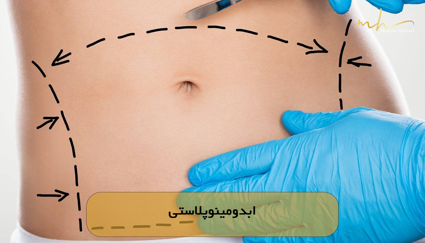 ابدومینوپلاستی