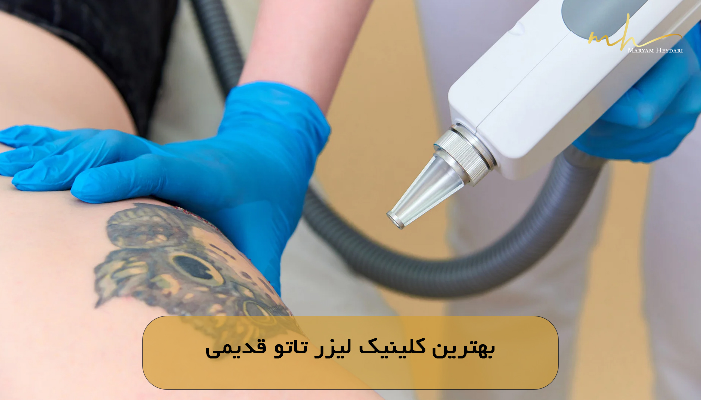 بهترین کلینیک لیزر تاتو قدیمی