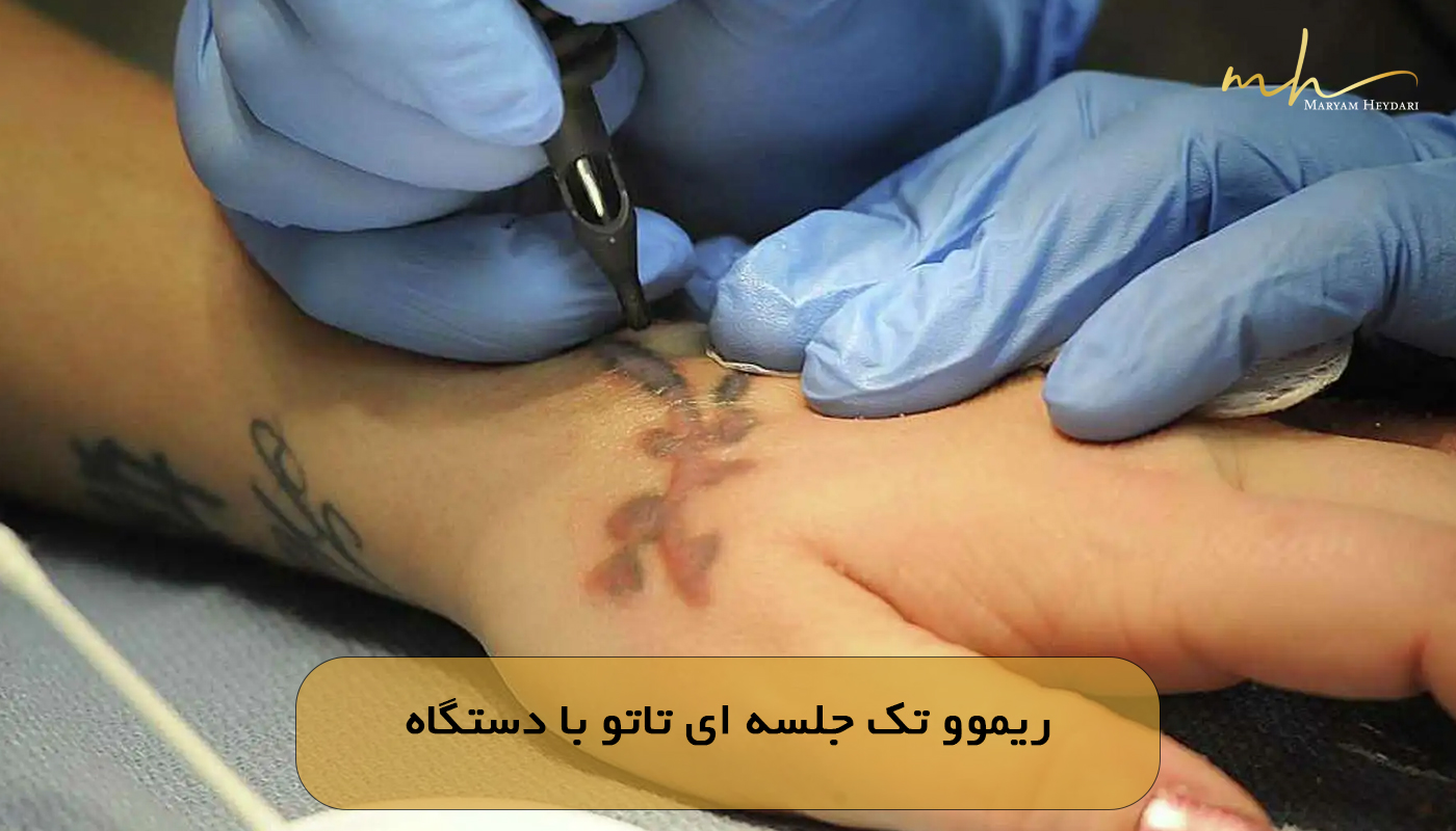 ریموو تک جلسه ای تاتو با دستگاه