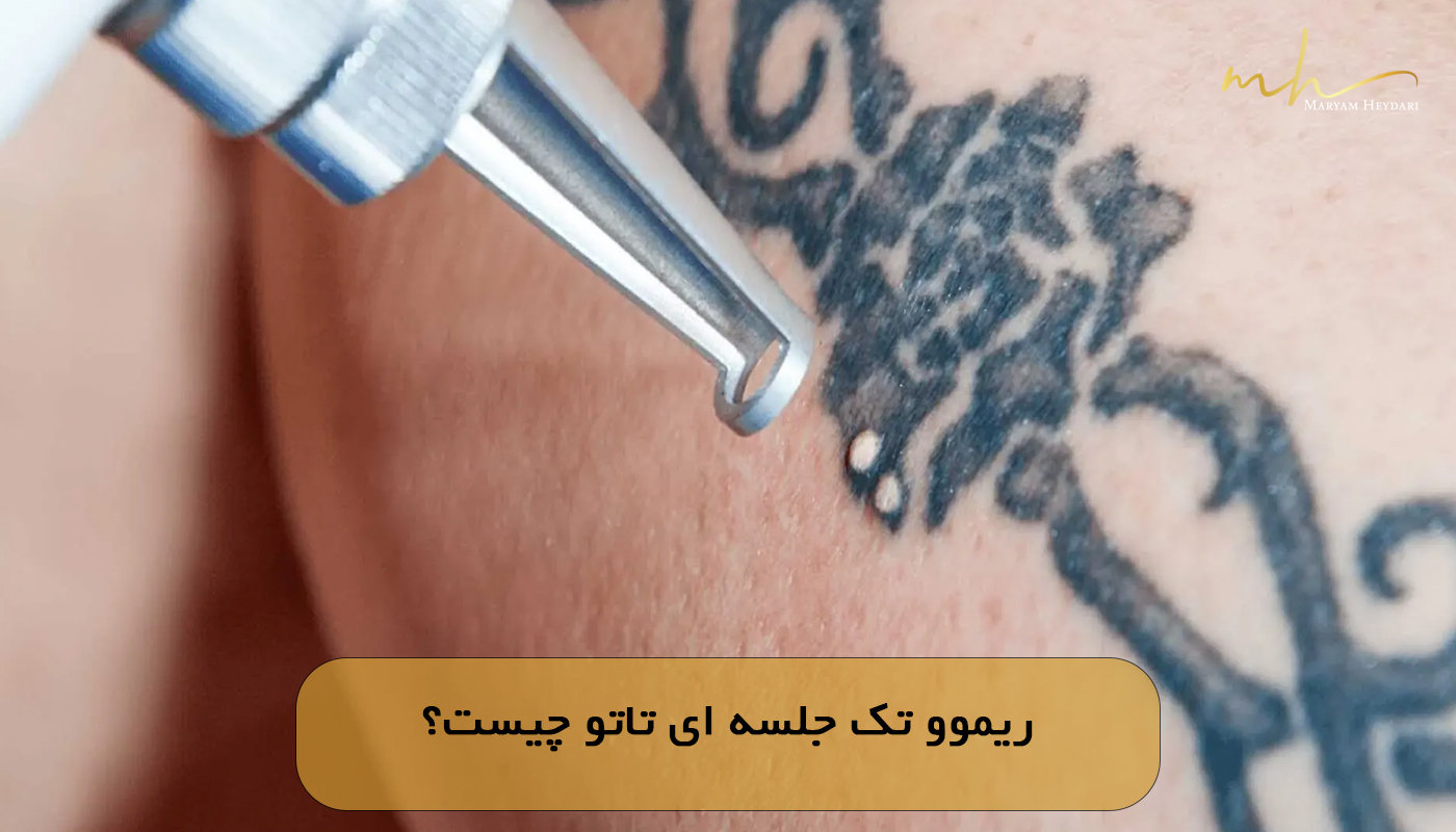 ریموو تک جلسه ای تاتو چیست؟