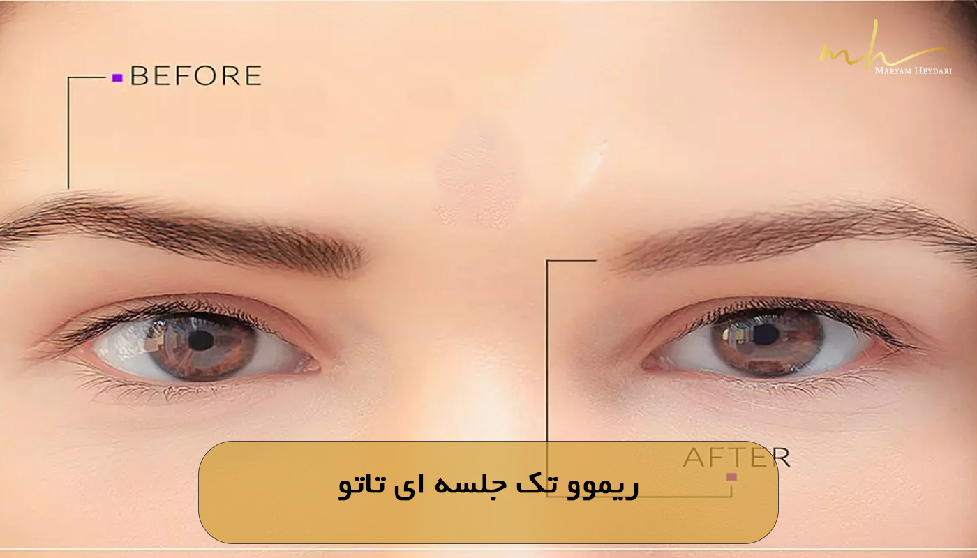 ریموو تک جلسه ای تاتو