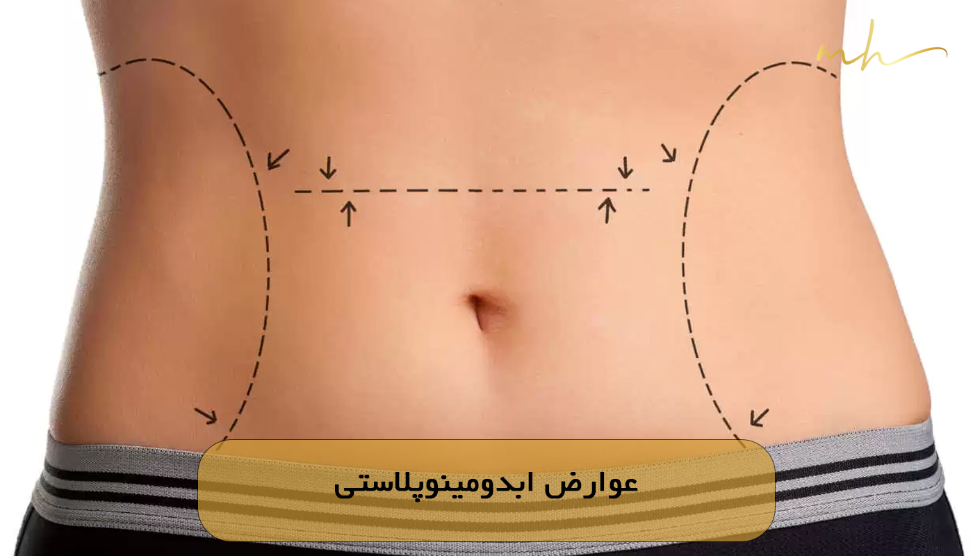 عوارض ابدومینوپلاستی